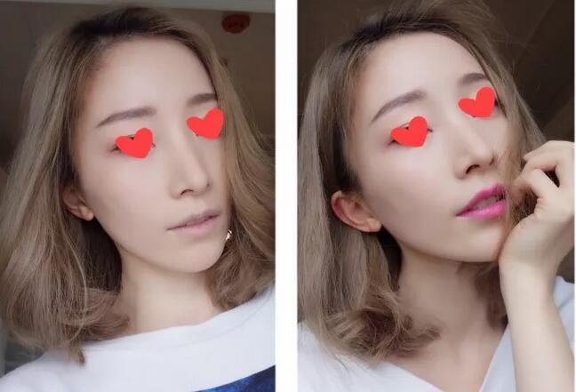 【热玛吉紧肤除皱是怎样一种体验？90后的她来聊聊一些亲身感受！】