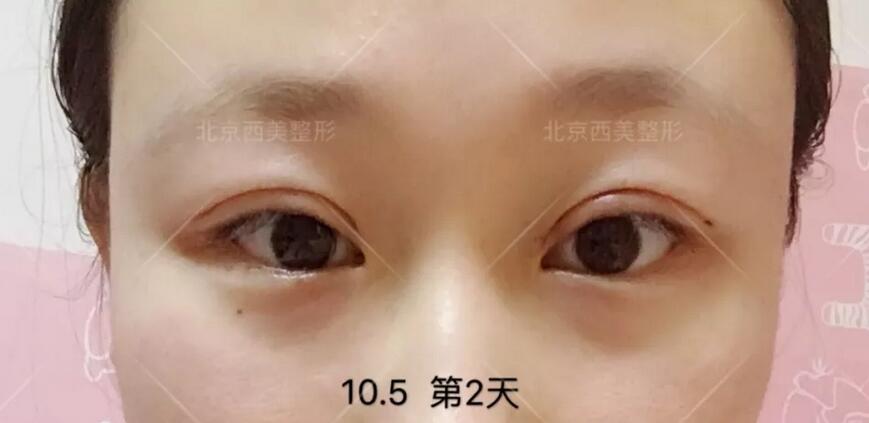 【芭比平行双眼皮的日记有没有发出来看下？我表妹想在今年做！】