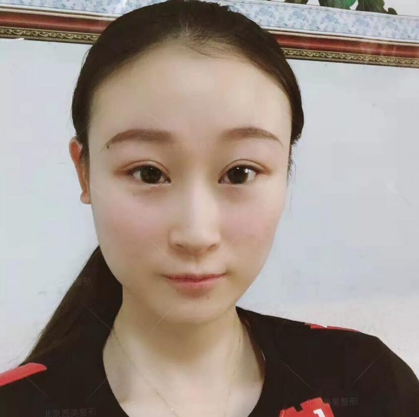 【芭比平行双眼皮的日记有没有发出来看下？我表妹想在今年做！】