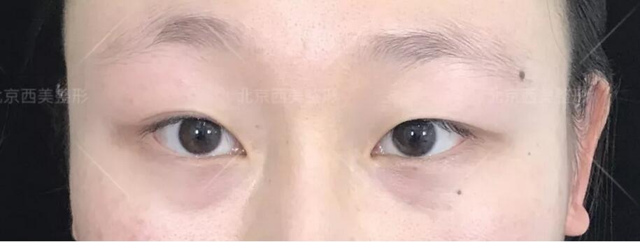 【芭比平行双眼皮的日记有没有发出来看下？我表妹想在今年做！】