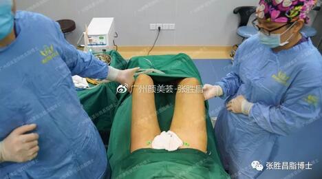 【大腿环吸案例】“从59cm到52cm，果较为满意，还想找你抽背”
