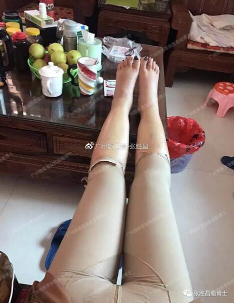 【大腿环吸案例】“从59cm到52cm，果较为满意，还想找你抽背”