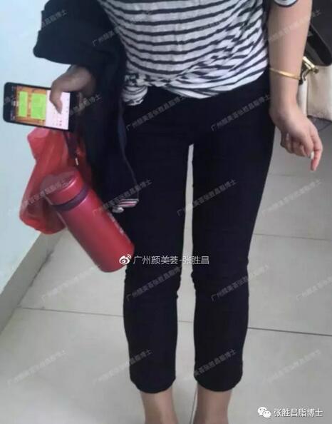 【大腿环吸案例】“从59cm到52cm，果较为满意，还想找你抽背”