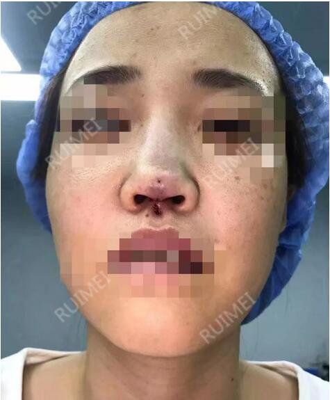 【美女隆鼻期待变美，却坏疽性溃疡险些毁容！】