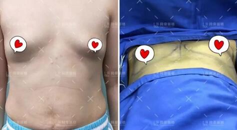 【自体脂肪细胞丰胸有后遗症吗？下面这则日记估计能给你答案！】