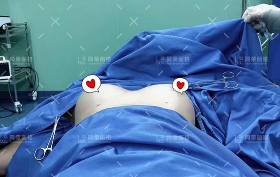 【自体脂肪细胞丰胸有后遗症吗？下面这则日记估计能给你答案！】