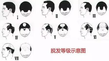 【fue植发的真实案例有木有，我舅脱发厉害慌着想做，想看下果图！】