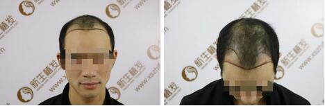 【fue植发的真实案例有木有，我舅脱发厉害慌着想做，想看下果图！】