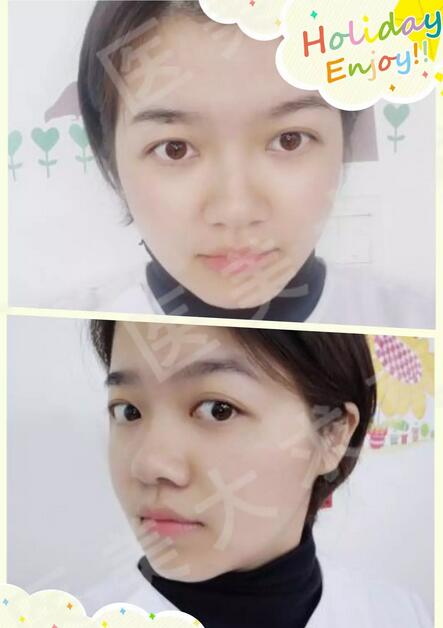 【注射瘦脸打几次能定型？这则案例里或许暗藏着你不知道的秘密！】