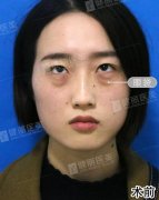 眼袋重怎么办？三姑今天QQ在线问我，我说我找下资料告诉她！ width=