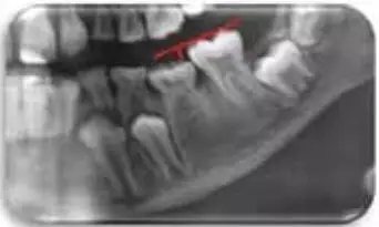 【睡觉磨牙是什么原因？缺钙吗？研究表明发生频率和发育情况相关！】