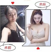 王合珍院长：直击你较关心的8大丰胸问题，本尊为你现场解答... width=