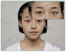 天生双眼皮还去割，结果比原来好看100倍！这是啥操作？ width=