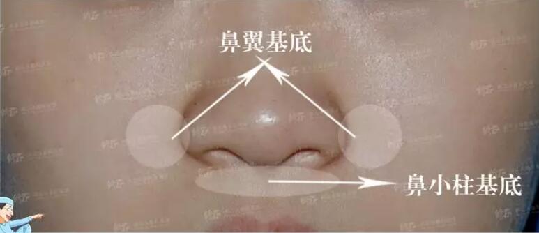 【垫鼻基底有多重要？这类问题还要我亲自来回答你？？？】