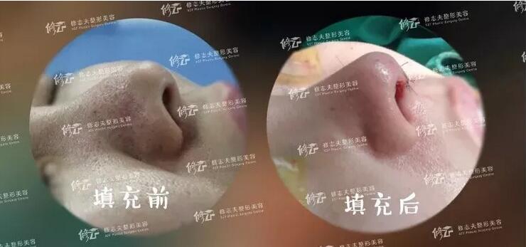 【垫鼻基底有多重要？这类问题还要我亲自来回答你？？？】