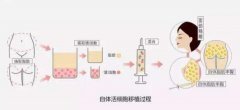 汪良明：自体活细胞丰胸多少钱？果怎么样？小case！ width=
