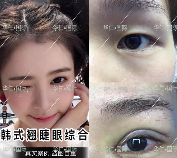 【眼部手术之韩式翘睫吸雕双眼皮——来自华仁医美邱富美的问候！】