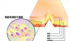 做填充用自体脂肪好还是玻尿酸好？来听听专业人士是咋个说滴！ width=