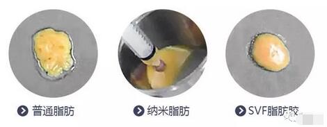 【脂肪胶(SVF-gel)科普篇来啦，记下来，不要说我没有讲过！】