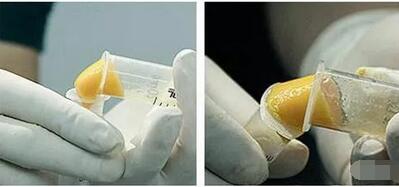 【脂肪胶(SVF-gel)科普篇来啦，记下来，不要说我没有讲过！】