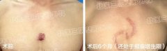 身上长的瘢痕疙瘩流脓了怎么办？ width=