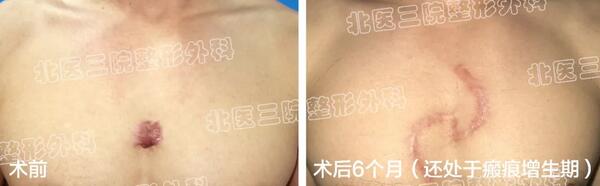 【身上长的瘢痕疙瘩流脓了怎么办？】