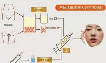 【五洲整形自体脂肪丰太阳穴果怎么样，会反弹吗？】
