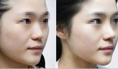 大白话小科普|今天说一说鼻基底 width=