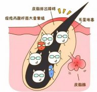 【专家解答】皮肤硬结痘痘，刷水杨酸有用吗？ width=
