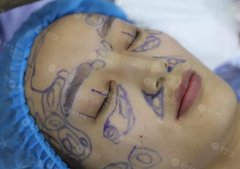 割双眼皮之前，医生在我脸上画的啥？ width=