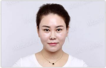 【美天达人秀****78】她做了埋线提升，竟然还有瘦脸果？！