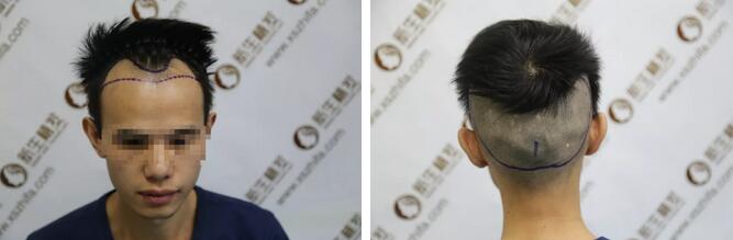 【发际线种植成功后，还会掉落吗？这篇日记讲得明明白白的！】