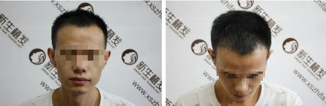 【发际线种植成功后，还会掉落吗？这篇日记讲得明明白白的！】