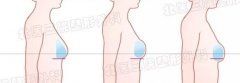 北医三院整形外科李比|乳癌术后组织扩张假体乳房再造 width=
