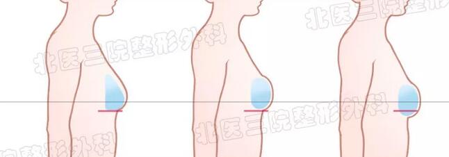 【北医三院整形外科李比|乳癌术后组织扩张假体乳房再造】