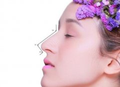 做l型假体隆鼻那种方法好 尽显美丽气质 width=