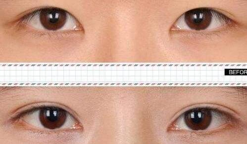 【做埋线双眼皮那种方法好 永葆高贵牌子】