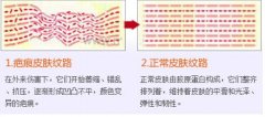 祛疤的三种方法，正确选择避免做无用功 width=