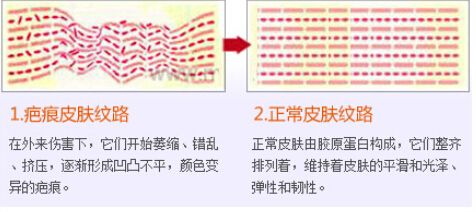 祛疤的三种方法，正确选择避免做无用功