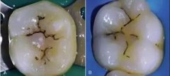 当牙齿出现黑线时，你的牙齿亮起了“红灯”！ width=