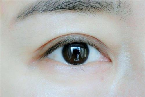 吸脂双眼皮哪种形状较自然?缘何遭到喜好