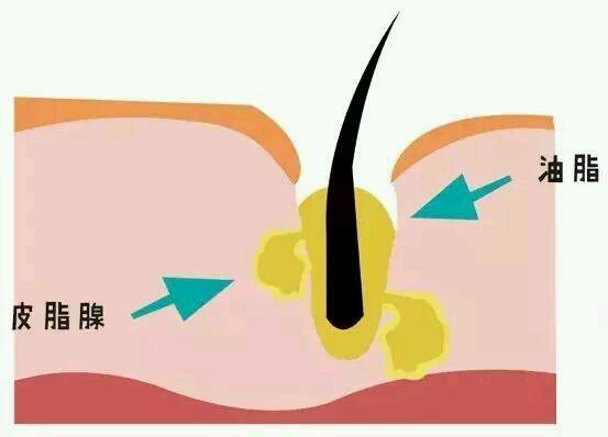 医美手段如何收缩毛孔?让毛孔隐形