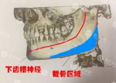 脸部轮廓整形手术到底痛不痛？跟着小编一起来学习这篇文章哦！ width=