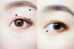 自体脂肪丰眼窝轻松打造微创双眸 width=