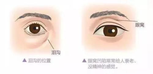 自体脂肪丰眼窝轻松打造微创双眸