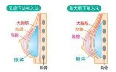 做韩式假体隆鼻手术方法有哪些？鼻部饱满线条 width=