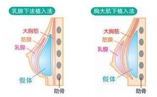 做韩式假体隆鼻手术方法有哪些？鼻部饱满线条