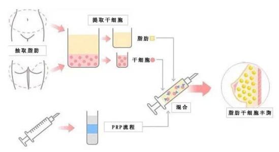 自体隆胸果如何，让我找回自信的感觉~