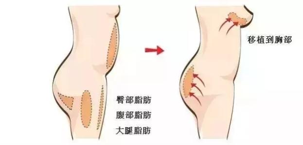自体隆胸果如何，让我找回自信的感觉~