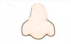 鼻翼缩小手术后遗症有吗？ width=